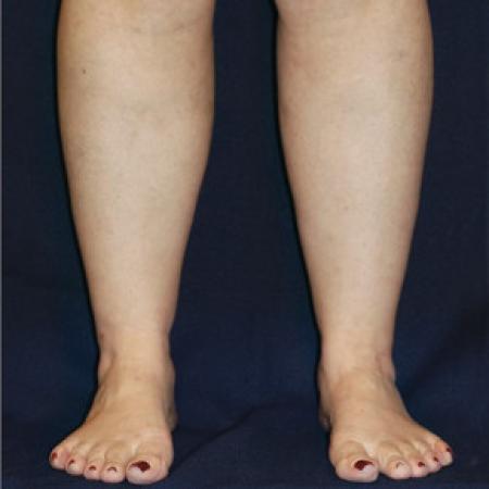 After image 1 Case #102686 - Lower Leg Liposuction