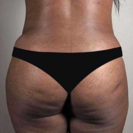 After image 3 Case #103171 - Tummy Tuck with Liposuction Patient 57