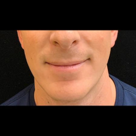 After image 3 Case #101561 - CHIN IMPLANT