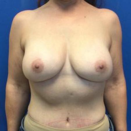 After image 1 Case #103316 - DIEP Flap and Phasix Mesh to the abdomen for a 31 year old female