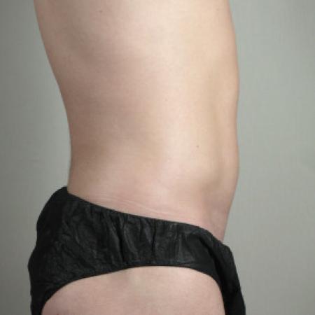 After image 2 Case #103131 - Liposuction of the Abdomen & Flanks Patient 70