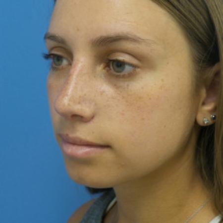 After image 2 Case #102191 - 22 year old  -  Rhinoplasty/Septoplasty/Turbinectomy  -  1 month post-op