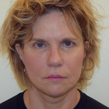 After image 1 Case #101576 - Facelift