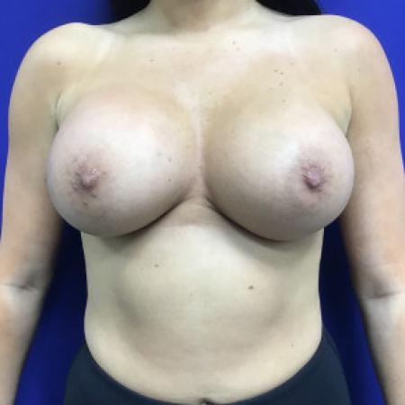 After image 1 Case #103216 - 34 B to 34 D-DD Breast Enhancement
