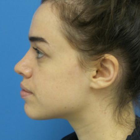 After image 3 Case #102236 - 22 year old  -  Open Rhinoplasty  -  3 months post-op