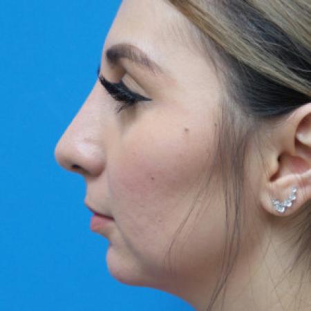After image 3 Case #102206 - 30 year old  -  Open Rhinoplasty & Chin Augmentation   3 months post-op