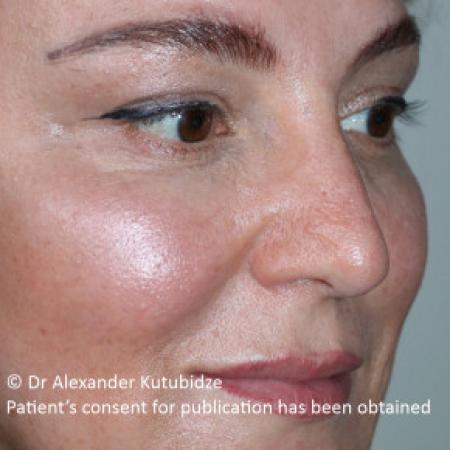 After image 2 Case #103366 - 8 years after aging aesthetic functional rhinoplasty secondary to previous teen age septoplasty 