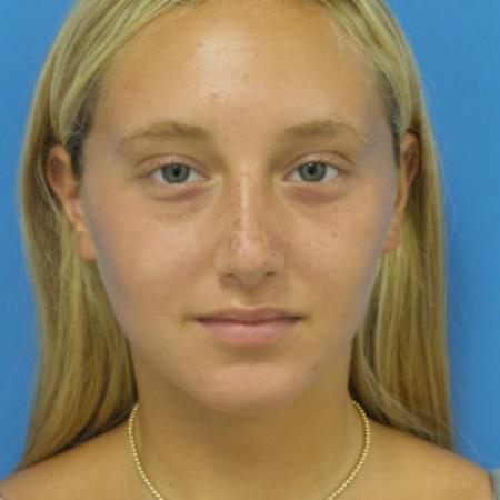 After image 1 Case #102301 - 17 year old  -  Open Septo-Rhinoplasty  -  3 months post-op