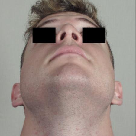 After image 3 Case #103126 - Rhinoplasty Patient 75