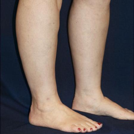 After image 2 Case #102686 - Lower Leg Liposuction