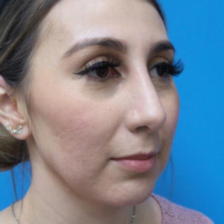 After image 2 Case #102206 - 30 year old  -  Open Rhinoplasty & Chin Augmentation   3 months post-op