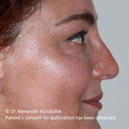 After image 5 Case #103366 - 8 years after aging aesthetic functional rhinoplasty secondary to previous teen age septoplasty 