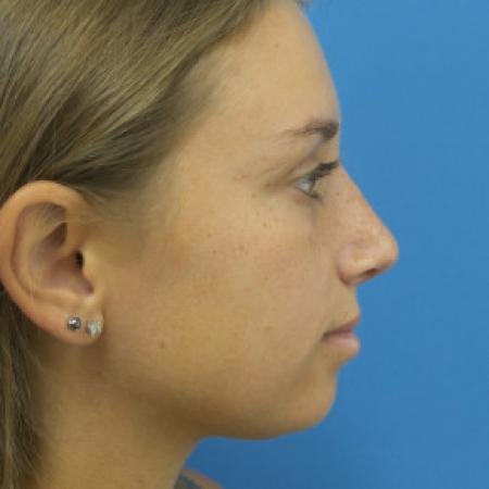 After image 3 Case #102191 - 22 year old  -  Rhinoplasty/Septoplasty/Turbinectomy  -  1 month post-op