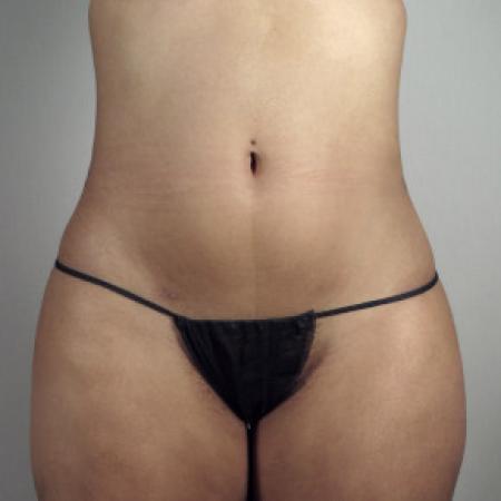After image 1 Case #103181 - Liposuction of the Hips Patient 30