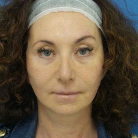 After image 1 Case #102266 - 55 year old  -  Facelift  -  2 months post-op