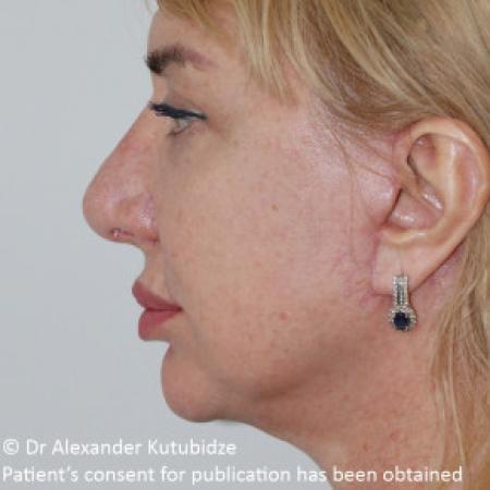 After image 4 Case #103361 - Deep Plane Face Lifting