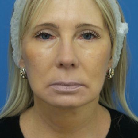 After image 1 Case #102321 - 60 year old  -  Necklift & Facelift  -  3 months post-op