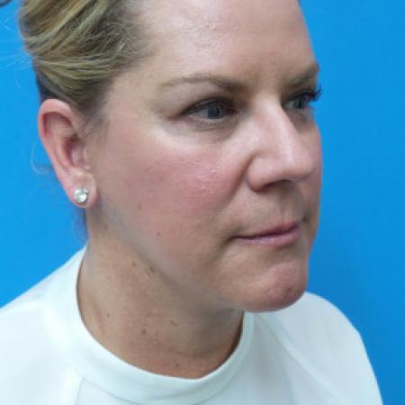 After image 2 Case #102331 - 52 year old  -  Facelift/Neck Lift/Upper Blepharoplasty  - 3 months post-op