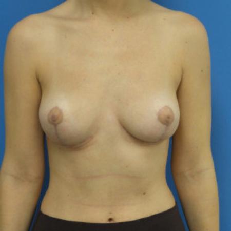 After image 1 Case #102186 - 27 year old  -  Bilateral Breast Reduction  -  2 months post-op