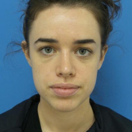 After image 1 Case #102236 - 22 year old  -  Open Rhinoplasty  -  3 months post-op
