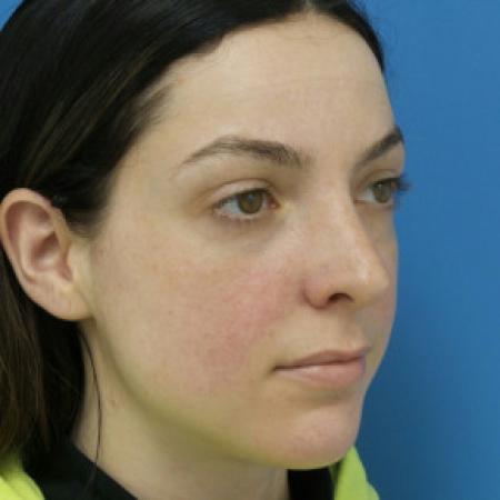 After image 2 Case #102211 - 30 year old  -  Closed Rhinoplasty/Septoplasty/Turbinectomy  -  3 months post-op