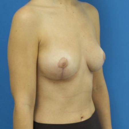 After image 2 Case #102186 - 27 year old  -  Bilateral Breast Reduction  -  2 months post-op