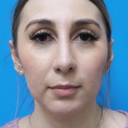 After image 1 Case #102206 - 30 year old  -  Open Rhinoplasty & Chin Augmentation   3 months post-op