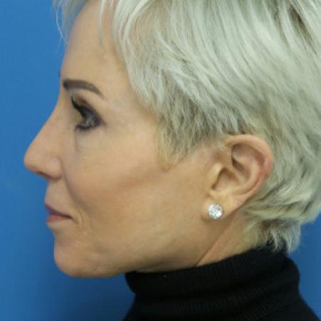 After image 3 Case #102246 - 65 year old  -  Open Secondary Rhinoplasty. Revision from another surgeon    1 month post-op