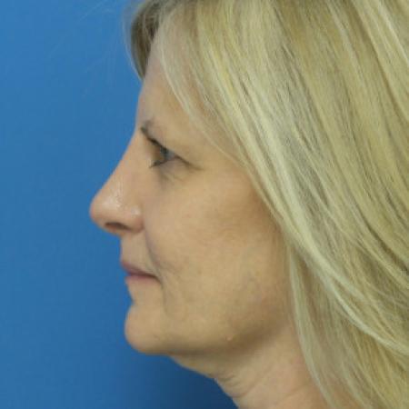 After image 3 Case #102241 - 56 year old  -  Open Rhinoplasty/Septoplasty/Turbinectomy  -  5 months post-op