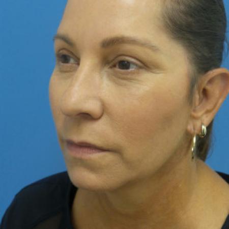 After image 2 Case #102166 - 53 year old  -  Facelift/Upper Blepharoplasty/TCA Peel to Lower lids/Otoplasty  -  2 months post-op