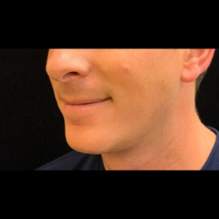After image 2 Case #101561 - CHIN IMPLANT