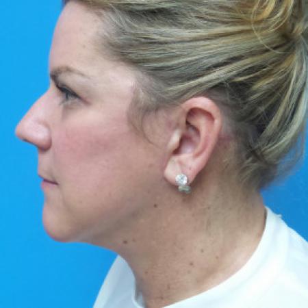 After image 3 Case #102331 - 52 year old  -  Facelift/Neck Lift/Upper Blepharoplasty  - 3 months post-op