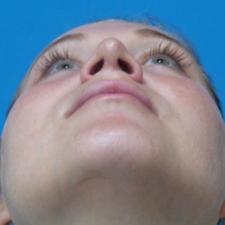 After image 4 Case #102306 - 25 year old  -  Open Rhinoplasty  -  6 months post-op
