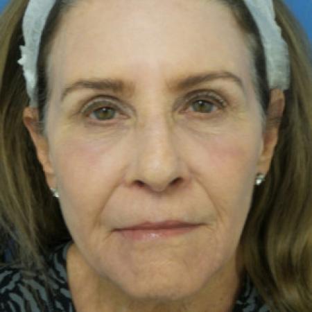 After image 1 Case #102261 - 71 year old  -  Upper & Lower Blepharoplasty/Upper Lip Lift/Full Face TCA Peel  -  2 months post-op