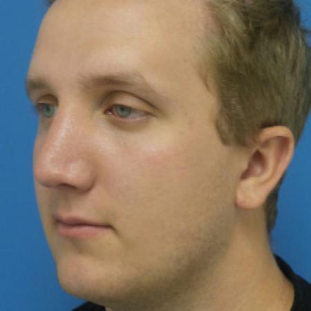 After image 2 Case #102296 - 19 year old  -  Open Septo-Rhinoplasty with Inferior Turbinectomies  -  3 months post-op
