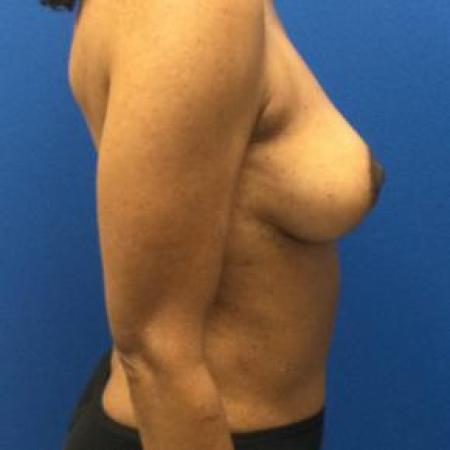 After image 3 Case #103306 - Mastopexy with autologous fat grafting to breasts and aAbdominoplasty for a 45 year old female