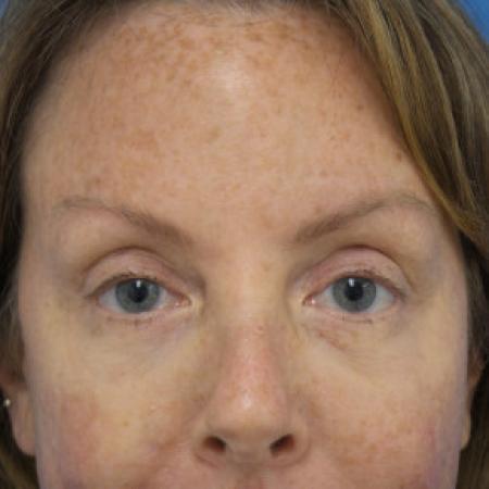 After image 1 Case #102256 - 44 year old -  Upper Blepharoplasty with Ptosis repair and Transconjunctival Lower Blepharoplasty