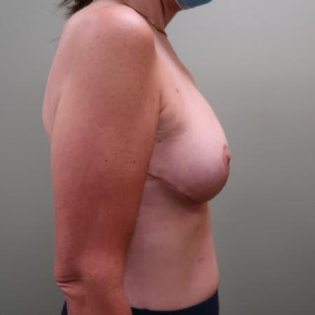 After image 2 Case #103396 - 50 year old female with bilateral breast lift