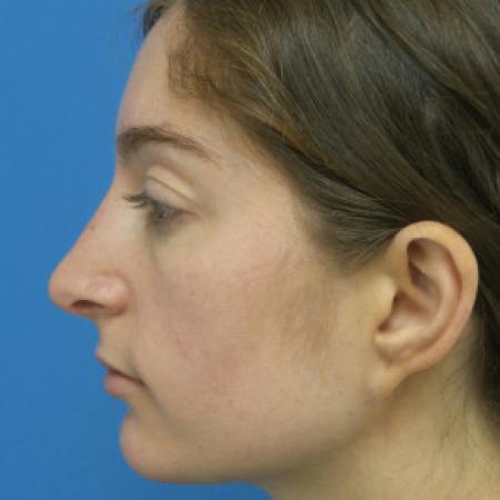 After image 3 Case #102271 - 28 year old  -  Open Rhinoplasty  -  6 months post-op