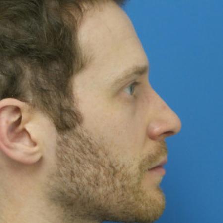 After image 1 Case #102251 - 31 year old  -  Open Rhinoplasty  -  3 months post-op