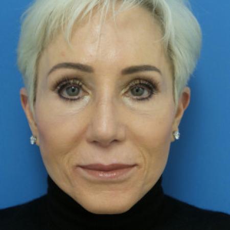 After image 1 Case #102246 - 65 year old  -  Open Secondary Rhinoplasty. Revision from another surgeon    1 month post-op