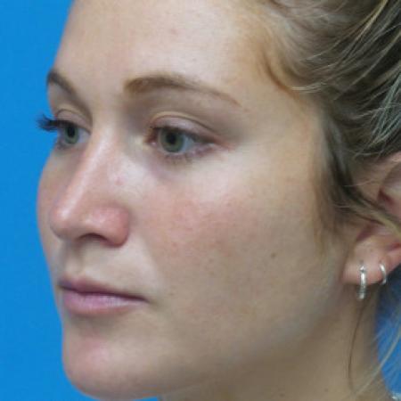 After image 2 Case #102306 - 25 year old  -  Open Rhinoplasty  -  6 months post-op