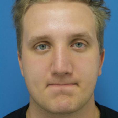 After image 1 Case #102296 - 19 year old  -  Open Septo-Rhinoplasty with Inferior Turbinectomies  -  3 months post-op