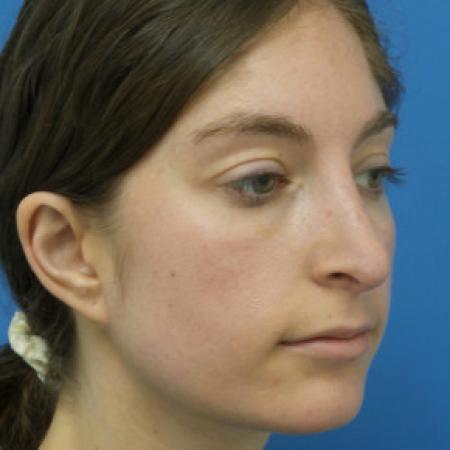 After image 2 Case #102271 - 28 year old  -  Open Rhinoplasty  -  6 months post-op