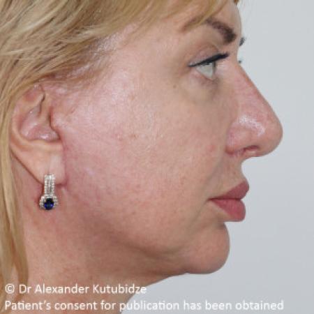 After image 5 Case #103361 - Deep Plane Face Lifting