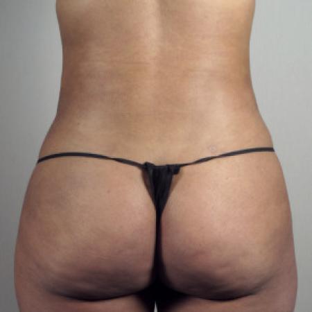 After image 3 Case #103181 - Liposuction of the Hips Patient 30
