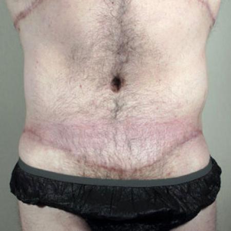 After image 1 Case #103176 - Tummy Tuck / Body Lift Patient 1