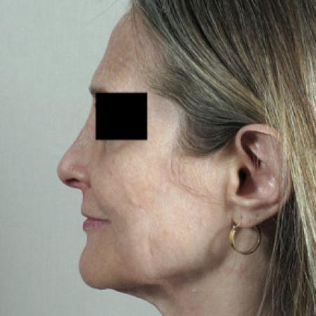 After image 2 Case #103151 - Rhinoplasty Patient 58
