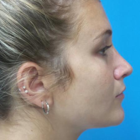 After image 3 Case #102306 - 25 year old  -  Open Rhinoplasty  -  6 months post-op