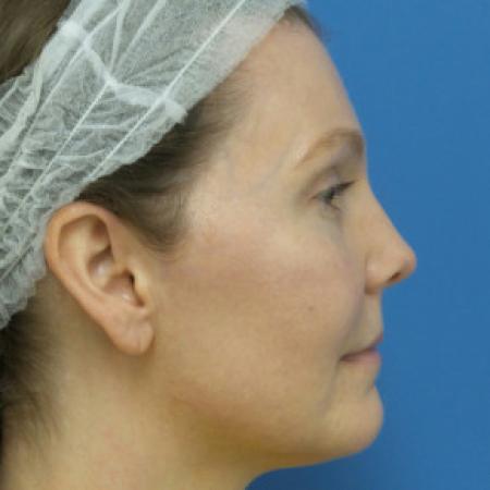 After image 2 Case #102231 - 39 year old  -  Endoscopic Browlift    5 months post-op
